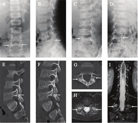 Results Of Lumbar Spine Radiography Computed Tomography Ct And