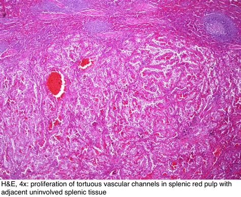Pathology Outlines Littoral Cell Angioma