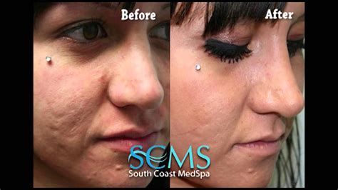Beforeafter Female Laser Acne Scar Removal Orange County Youtube