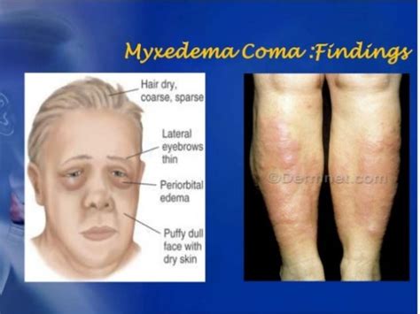 Myxedema Coma