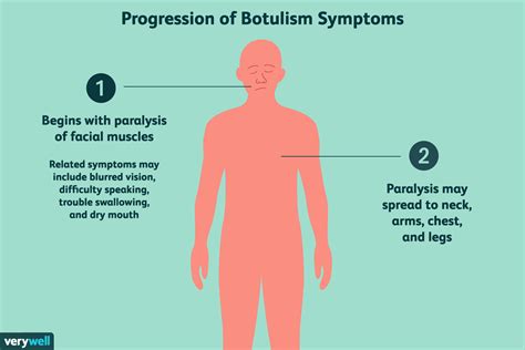 Botulism Overview And More