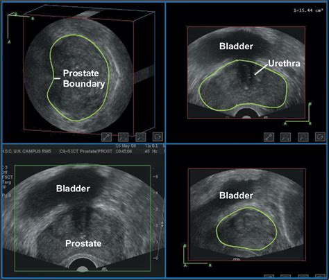 Prostate Anatomy Ultrasound
