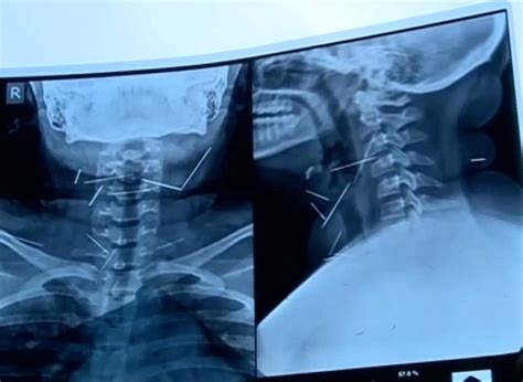 Photo Gallery Girl Complains Of Throat Pain Doctors Discover Needles Stuck News Zee News