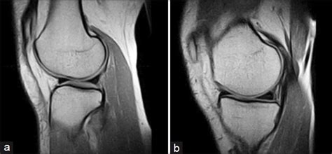 Arthroscopic And Low Field Mri T Evaluation Of Meniscus And Ligaments Of Painful Knee
