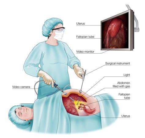 Laparotomy and operative laparoscopy both play important roles in treating women's health issues. For Women Archives - Pelvic Pain Foundation