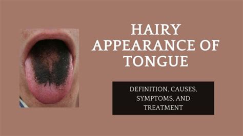 Hairy Appearance Of Tongue Definition Causes Symptoms And Treatment