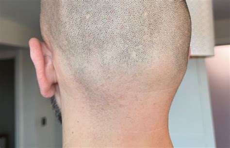 How To Prevent Treat Razor Bumps On The Back Of Your Head