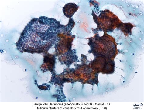 Pathology Outlines Thyroid Follicular Nodular Disease Multinodular