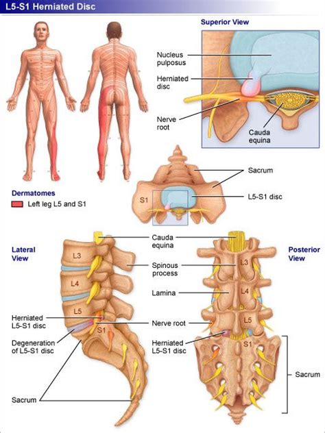 A procedure that uses a combination of large magnets, radiofrequencies, and a computer to produce detailed images lumbar disk disease may occur when a disc in the low back area of the spine bulges or herniates from between the bony area of the spine. L5 Disc Gallery