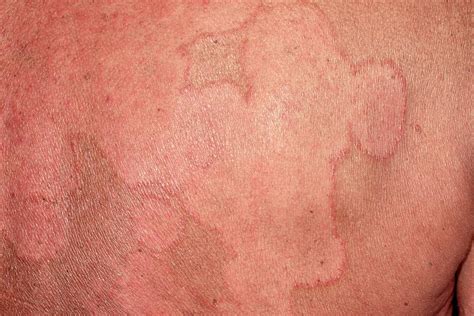 Ringworm Rash Photograph By Dr P Marazziscience Photo Library