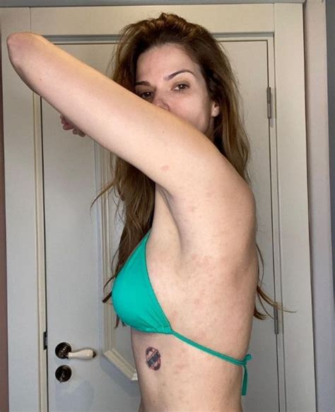 Ünlü model Laeisa Gacemer paylaştığı fotoğrafla hastalığa yakalandığını
