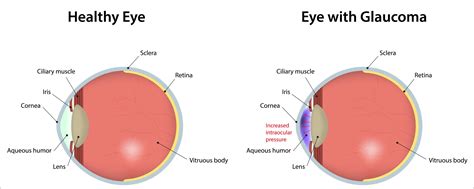 Longitudinal glaucoma screening for siblings of patients with primary open angle glaucoma: Glaucoma: 10 Facts Everyone Should Know - Optix Eye Care
