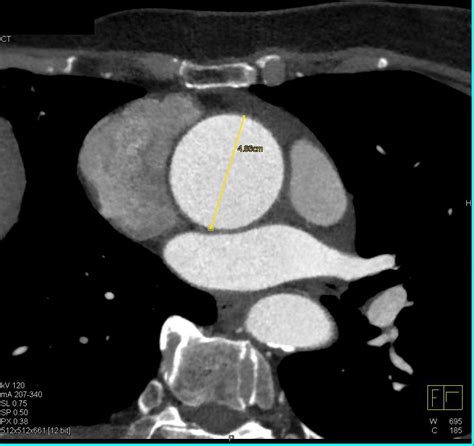 Dilated Ascending Thoracic Aorta Chest Case Studies Ctisus Ct Scanning