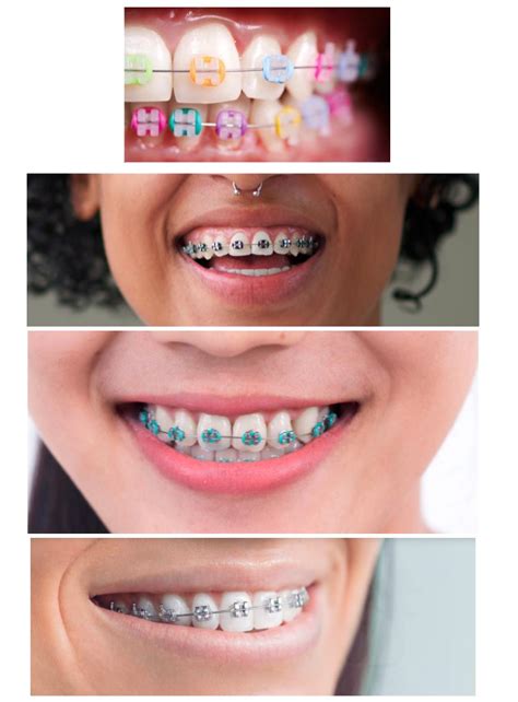 How To Pick Aesthetic Colors For Your Braces Reese