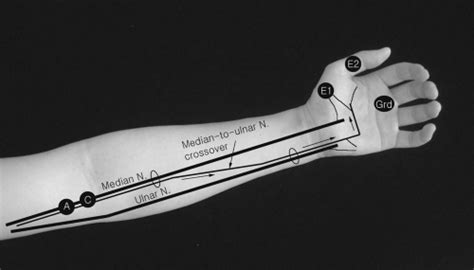 Upper Extremity | Musculoskeletal Key