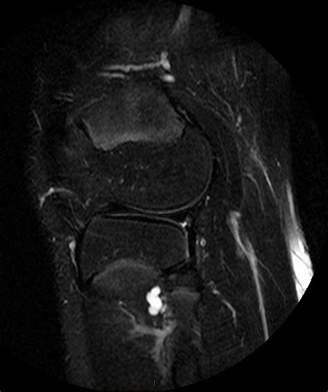 Intraneural Ganglion Cyst Of The Tibial Nerve In A Child Eurorad