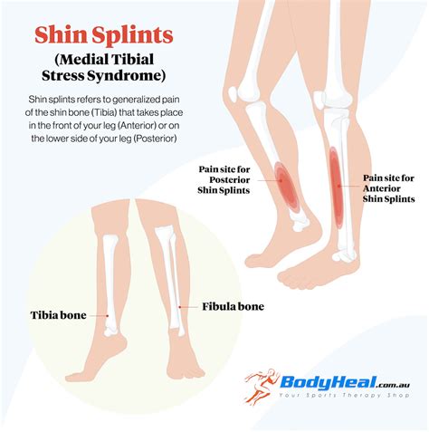 What Is Shin Splints Causes Symptoms And Treatment Options Bodyheal