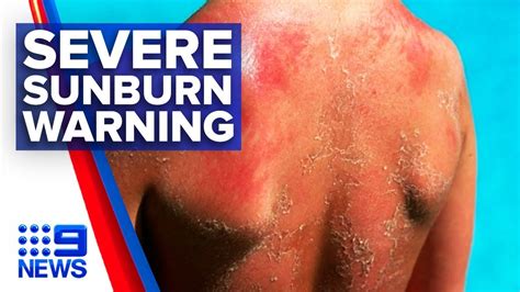 Hospital Emergency Visits Increase For Severe Sunburn Cases Nine News Australia Youtube