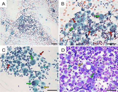 Cytological Findings Of The Lymph Node From Fna A And B Papanicolaou