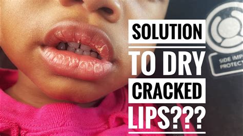 Solution For Toddlers Dry Cracked And Peeling Lips Youtube