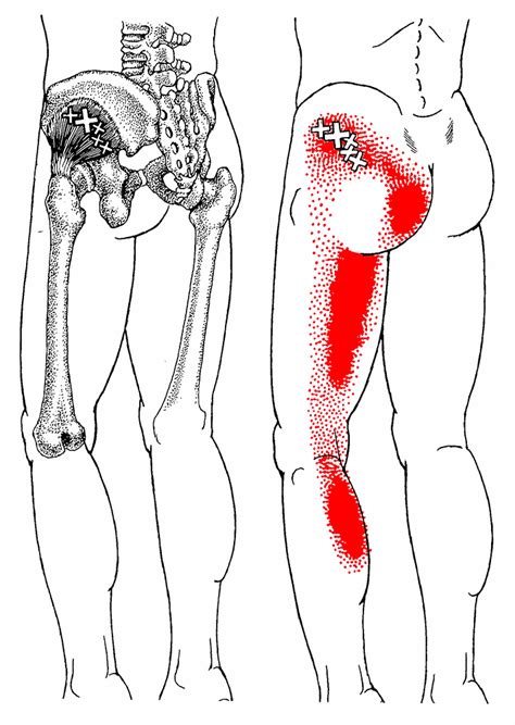 The Trigger Point Referred Pain Guide 14
