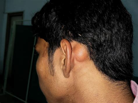 Swelling Behind Ear