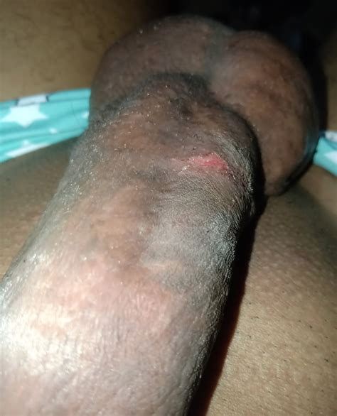 Injury To The Penis Pics Xhamster