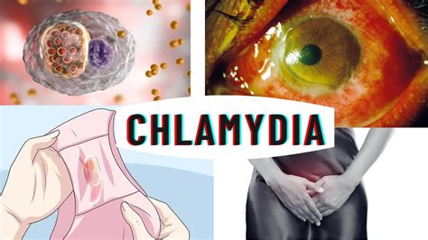Chlamydia Infection Causes Symptoms Complications And Diagnosis Youtube