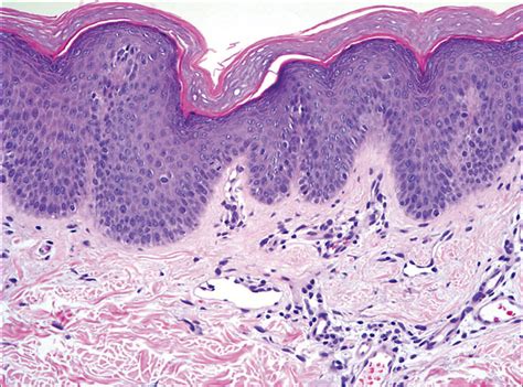 Confluent Scaly Erythematous Plaques On The Trunk Of A 16 Year Old Boy