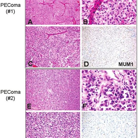 Malignant Melanoma Sections Of Primary Melanoma Superficial Spreading