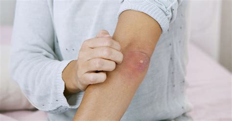 Pimple On Your Elbow Main Causes And Treatments