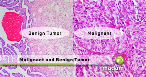 Difference Between Malignant And Benign Tumor Biomadam