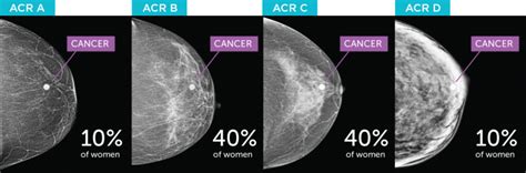 how dense breasts can affect your cancer screenings — health insight