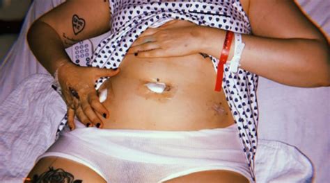 A endometriose é uma doença benigna, que se caracteriza pela proliferação do tecido chamado endométrio para fora da cavidade uterina, local em que ele normalmente se desenvolve. Endométriose: Lena Dunham se confie sur son lit d'hôpital ...