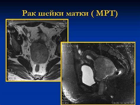 Диета рак шейки матки Возможности лучевых методов диагностики в оценке состояния шейки Возможности лучевых методов диагностики в оценке состояния шейки Диета рак шейки матки