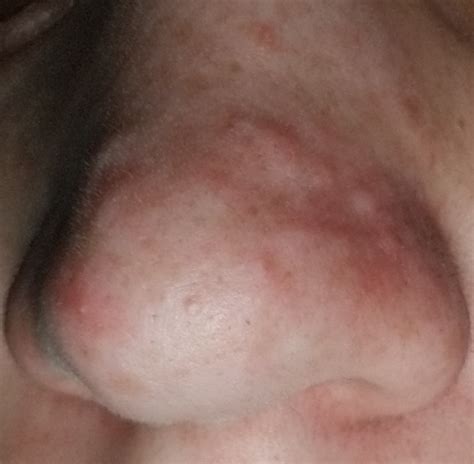 Skin Colored Bumps That Have Been Present For Years With