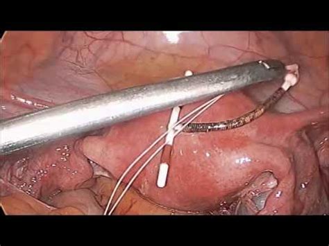 Have a disorder that causes too much copper to accumulate in your liver, brain and other had the iud inserted immediately after childbirth. Laparoscopic Removal of a Perforated Intrauterine Device by Dr. R.K. Mishra - YouTube