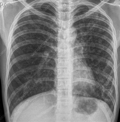 Lung Abscess X Ray Stock Image F0365530 Science Photo Library