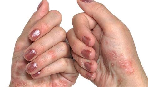 Type 2 Diabetes Skin Itching Could Be An Early Sign Uk