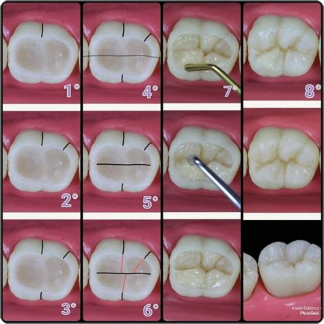 Composite Restoration Odontologia Assistente De Dentista Dentário