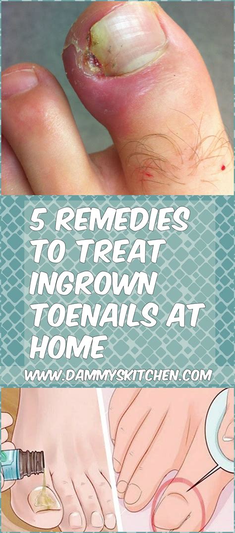 5 Remedies To Treat Ingrown Toenails At Home #health #ingrownnails #