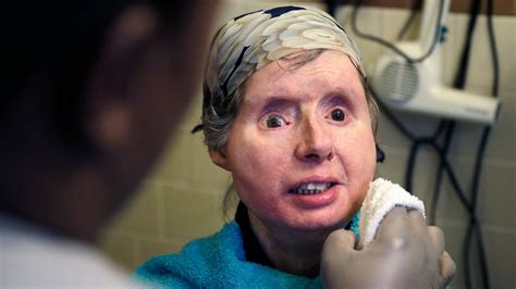 Chimpanzee Attack Victim Who Got Face Transplant Is Hospitalized The