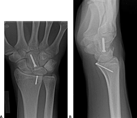 Headless Bone Screw Fixation For Combined Volar Lunate Facet Distal Radius Fracture And Capitate