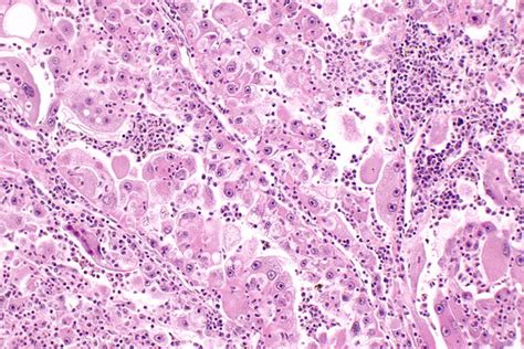 Renal Cell Carcinoma With Rhabdoid Morphology Libre Pathology