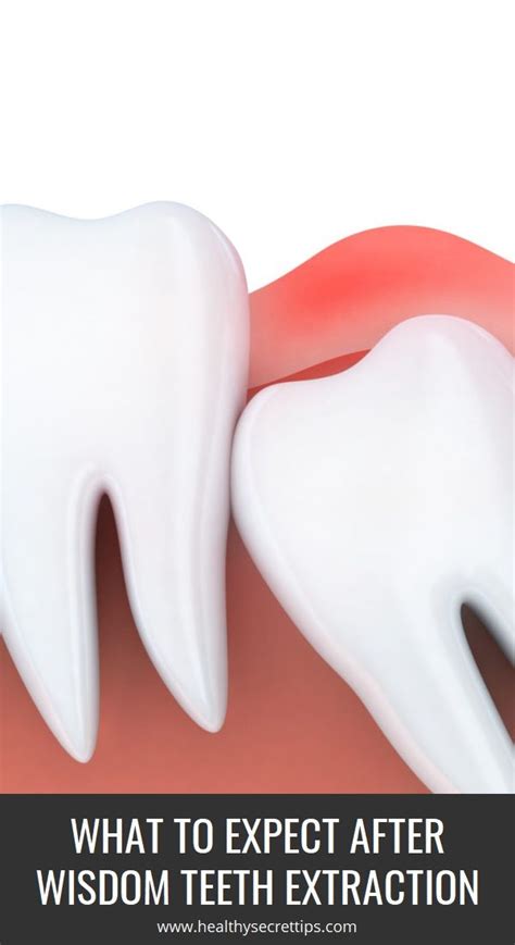 It not only reduce pain, swelling, and inflammation but also a power healer that can kill bacteria and prevent infection causing such pain into your mouth. What to Expect After Wisdom Teeth Extraction (With images ...