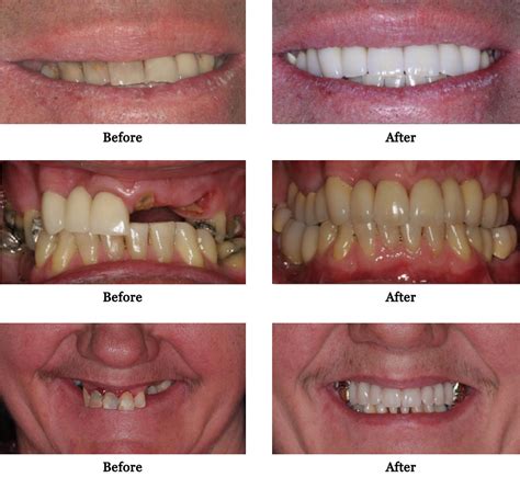 Full Mouth Rehabilitation Tauranga Dental Specialists
