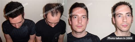 How do you take it? Facial Changes From Taking Propecia | Page 4 ...