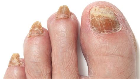 How To Get Rid Of Yellow Toenails Fast In 2021 Toe Nails Yellow Toe