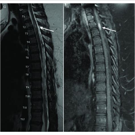 Legend G And H Mri Of The Thoracic Spine T Weighted Sagittal Download Scientific Diagram