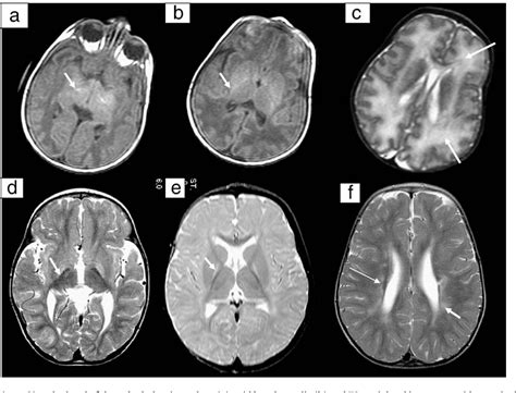 Figure 3 From Serial Brain Mri And Ultrasound Findings Relation To